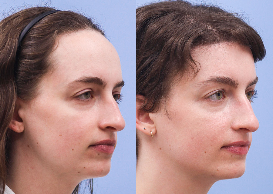 Before and After Forehead Lift