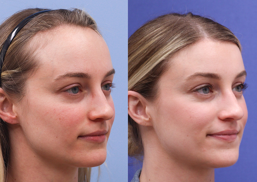 Before and After Forehead Lift