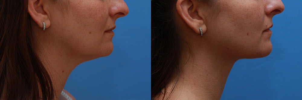 Neck Lift Boston | Best Neck Lift Surgery in Worcester