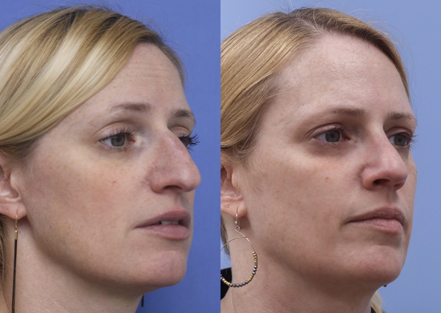 Before and After Rhinoplasty in Boston