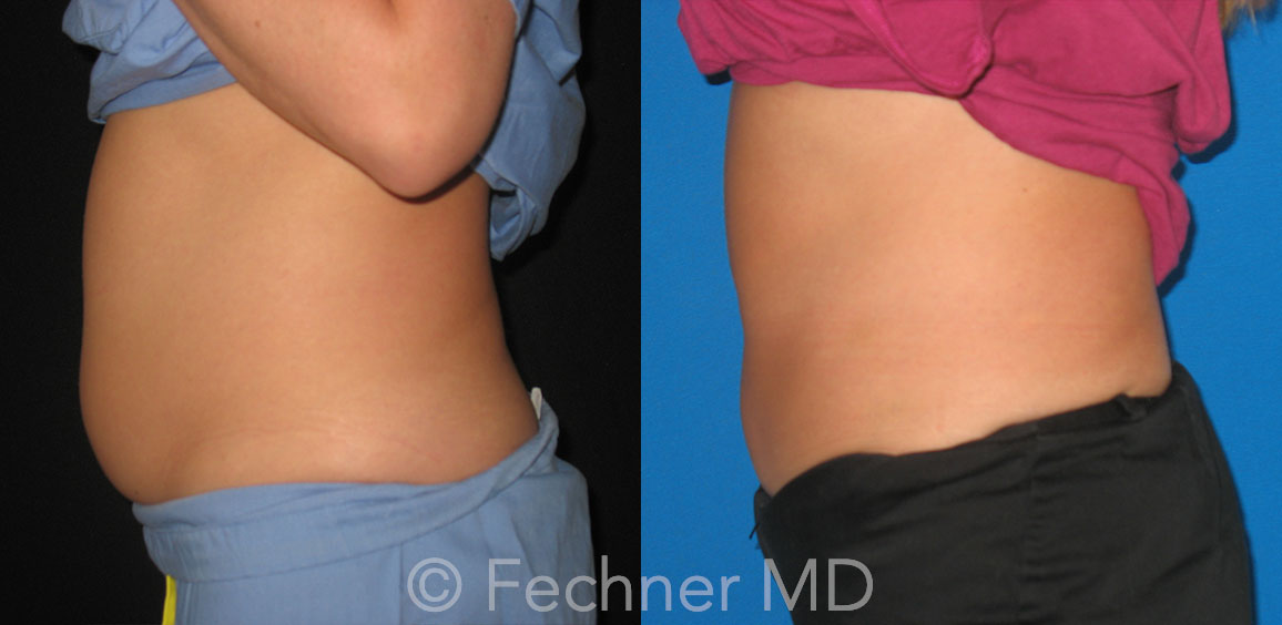 Coolsculpting Before and After 01