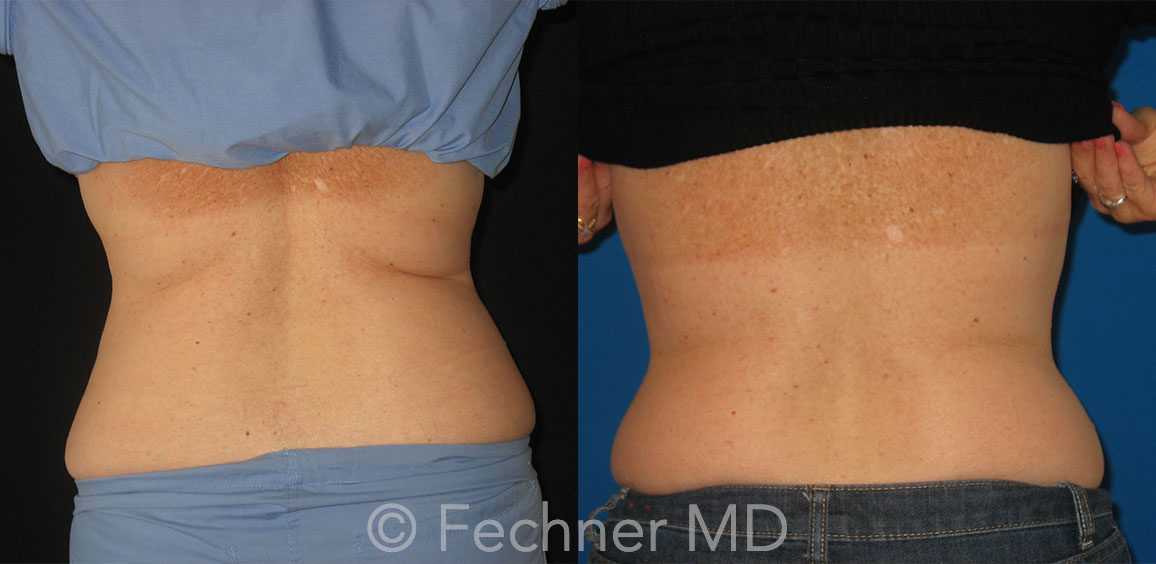 Coolsculpting Before and After 03