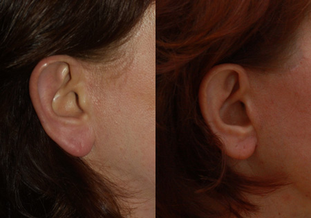 Ears Before and After 01