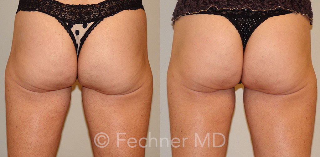 Emsculpt Before and After 01