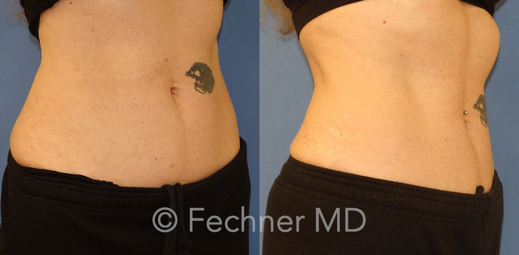 Emsculpt Before and After 02