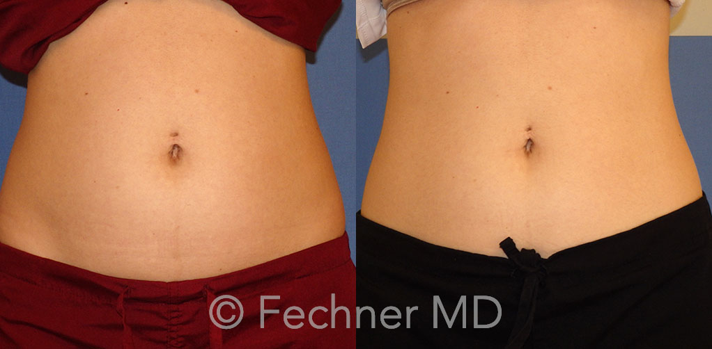 Emsculpt Before and After 04