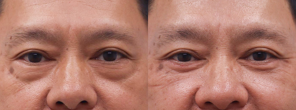 Eyelids Before and After 22