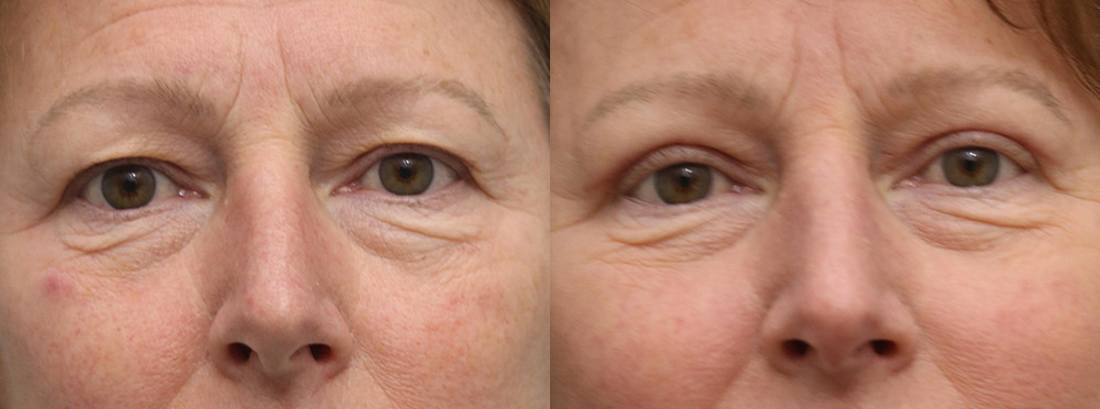 Eyelids Before and After 22