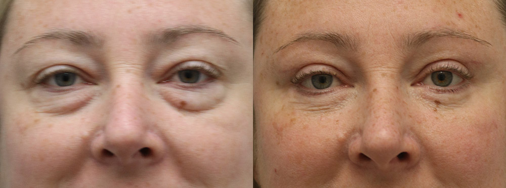 Eyelids Before and After 12