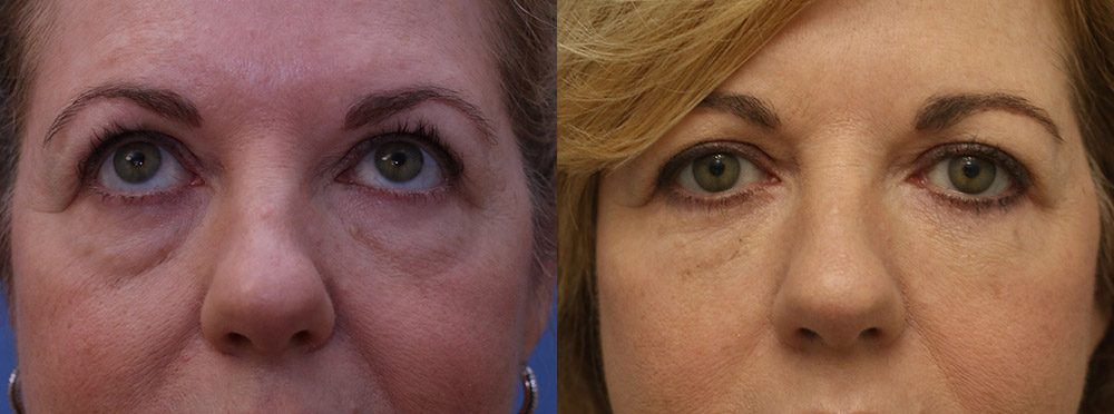 Eyelids Before and After 24