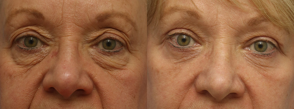 Eyelids Before and After 11