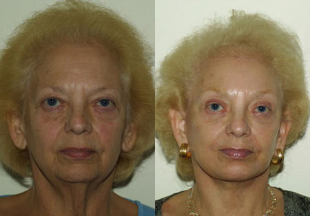 Face Before and After 25