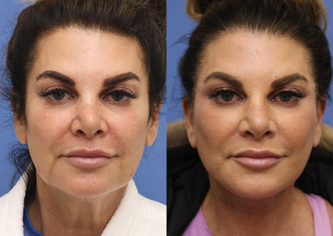 Face Before and After 38