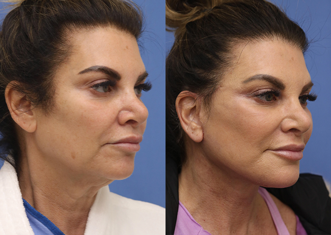 Face Before and After 39