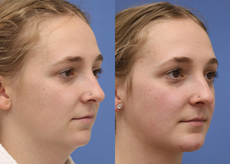 Facial Implants Before and After 11
