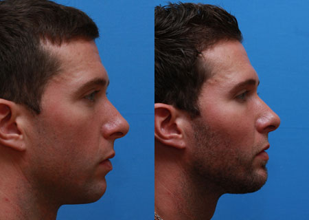 Facial Implants Before and After 07