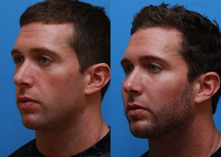 Facial Implants Before and After 05