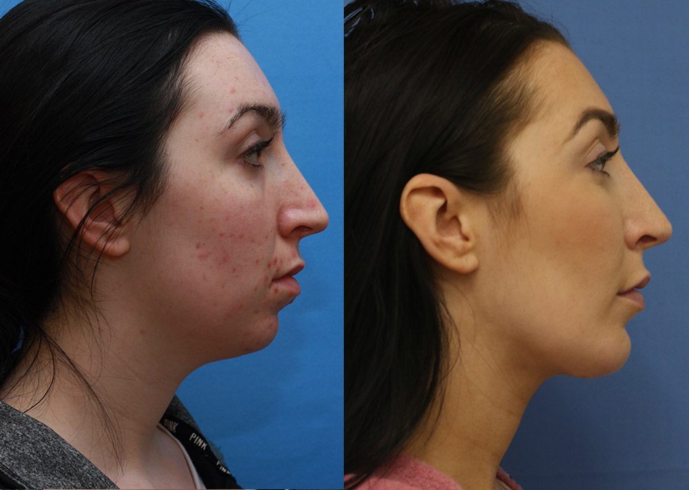 Facial Implants Before and After 07