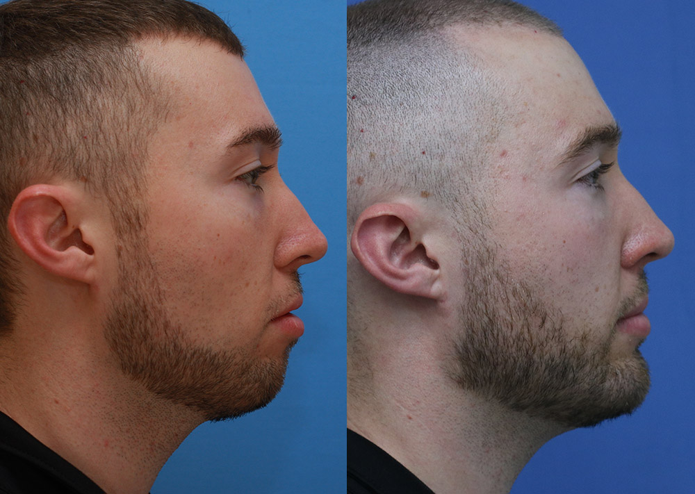 Facial Implants Before and After 12