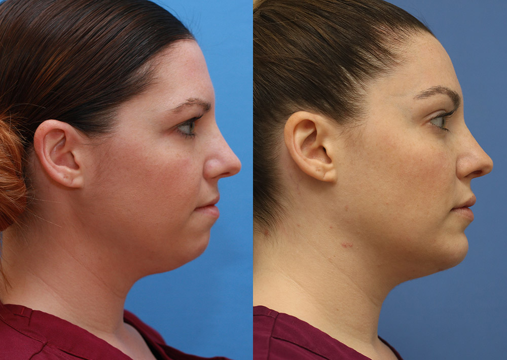 Facial Implants Before and After 11