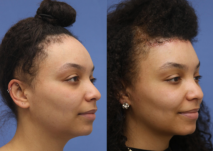 Forehead Reduction Before and After 01