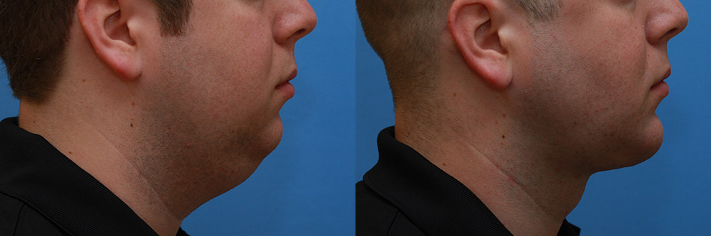 Neck Before and After 03