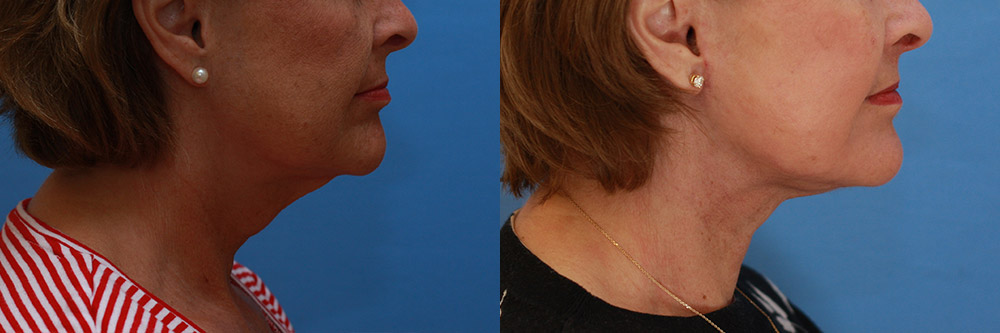 Neck Before and After 01