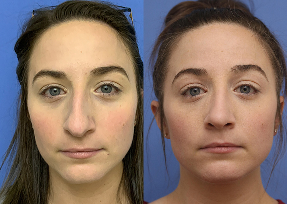 Nose Before and After 23