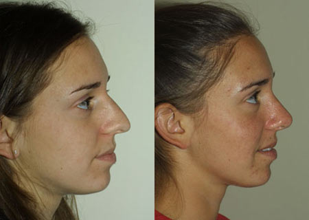 Nose Before and After 20