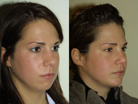 Nose Before and After 24