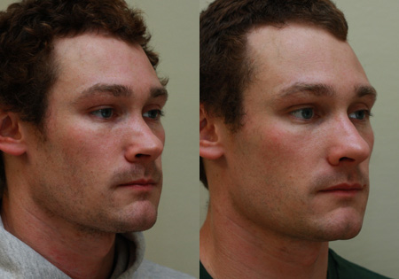Nose Before and After 24