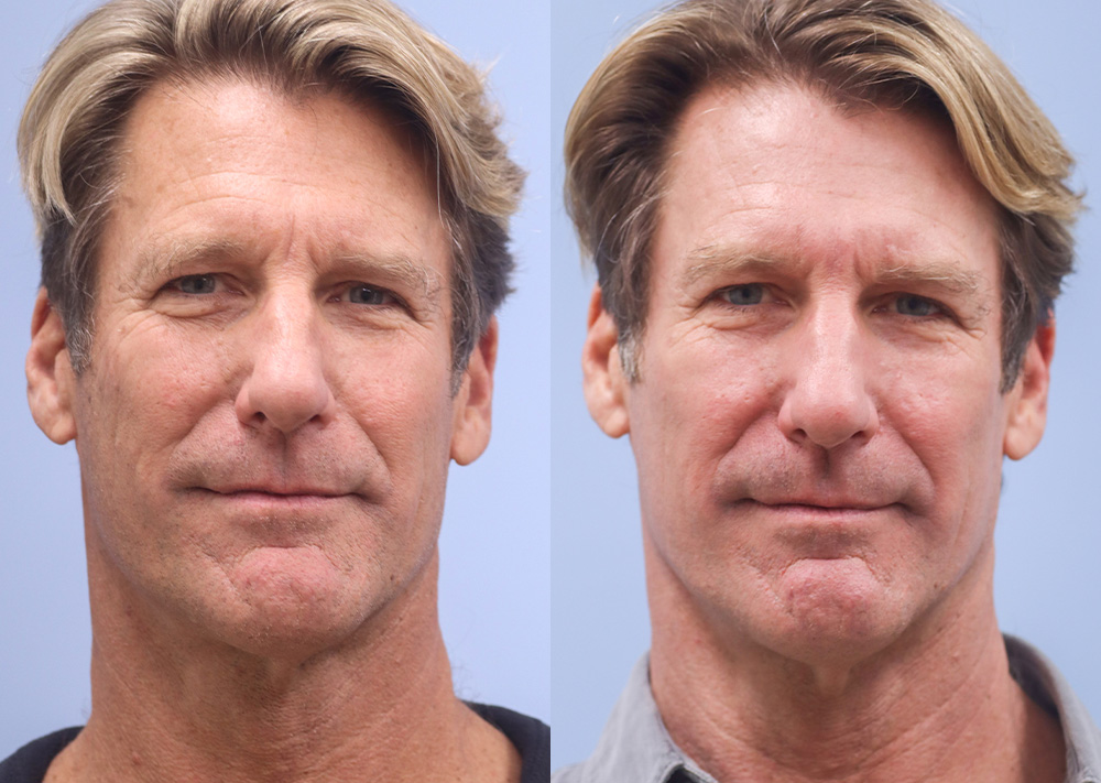 Skin Rejuvenation Before and After 01