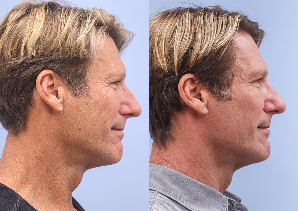 Skin Rejuvenation Before and After 01